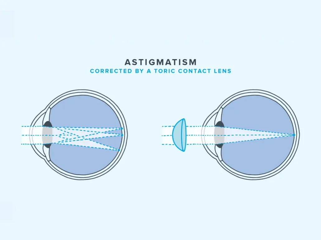 لنز چشم آستیگمات چیست؟