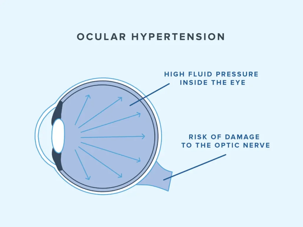 محدوده فشار طبیعی چشم چیست؟